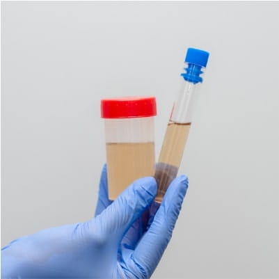 Posiew moczu - badanie mikrobiologiczne, wykonywane w diagnostyce zakażeń układu moczowego